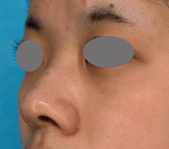 耳介軟骨移植（鼻先を出す）,耳介軟骨移植・小鼻縮小・鼻尖形成を行って洗練された印象の鼻になった症例写真,Before,ba_jikai058_b02.jpg