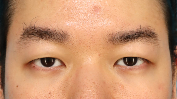 二重まぶた・全切開法,二重まぶた全切開法で自然な末広型二重を作った30代男性の症例写真,手術前,mainpic_sekkai107a.jpg