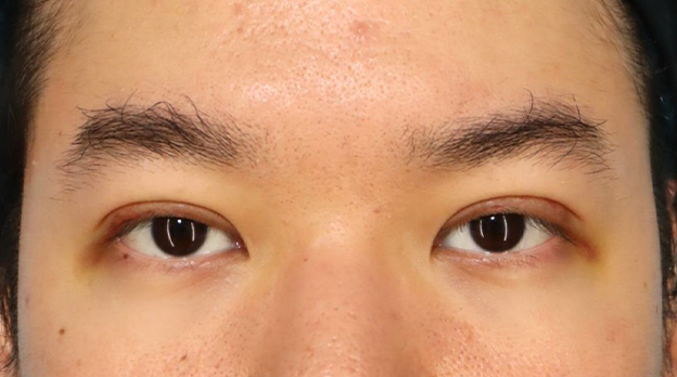 二重まぶた・全切開法,二重まぶた全切開法で自然な末広型二重を作った30代男性の症例写真,1週間後,mainpic_sekkai107c.jpg