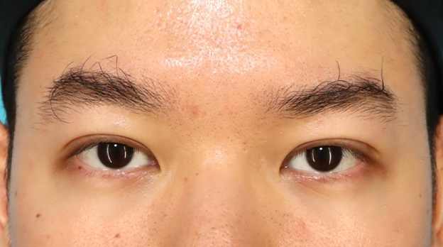 二重まぶた・全切開法,二重まぶた全切開法で自然な末広型二重を作った30代男性の症例写真,2ヶ月後,mainpic_sekkai107d.jpg