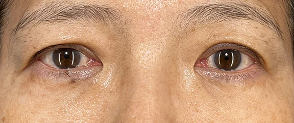 目の下の脂肪取り,目の下の脂肪取りで明るくハリのある目元にした症例写真,After（1ヶ月後）,ba_shibo_under017_a01.jpg