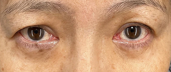 目の下の脂肪取り,目の下の脂肪取りで明るくハリのある目元にした症例写真,After(1ヶ月後),ba_shibo_under017_b02.jpg