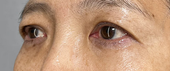 目の下の脂肪取り,目の下の脂肪取りで明るくハリのある目元にした症例写真,After(1ヶ月後),ba_shibo_under017_b03.jpg