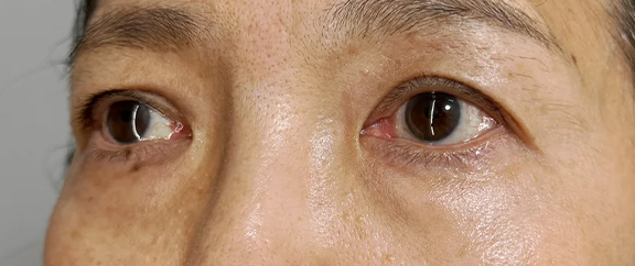 目の下の脂肪取り,目の下の脂肪取りで明るくハリのある目元にした症例写真,Before,ba_shibo_under017_b03.jpg