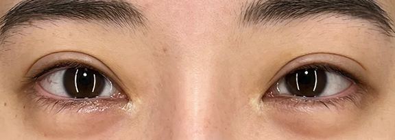 目尻切開,目尻切開で切れ長で大きな目を作った症例写真,Before,ba_mejiri027_b01.jpg