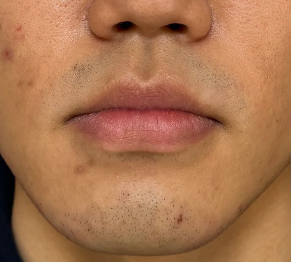 口唇縮小術で唇を薄くした症例写真,After（3ヶ月後）,ba_usuku026_a01.jpg