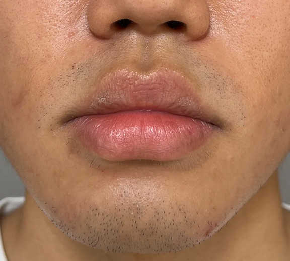 口唇縮小術で唇を薄くした症例写真,Before,ba_usuku026_b01.jpg