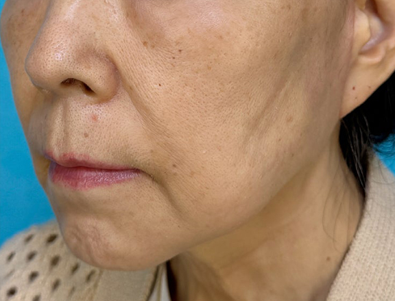 症例写真,ミニフェイスリフト(頬のたるみ取り)を行い、顎とフェイスラインを引き締めた70代女性の症例写真,After(1ヶ月後),ba_minilift024_b02.jpg