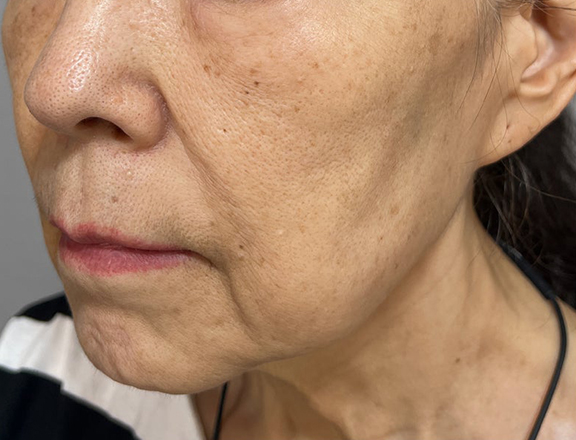 症例写真,ミニフェイスリフト(頬のたるみ取り)を行い、顎とフェイスラインを引き締めた70代女性の症例写真,Before,ba_minilift024_b02.jpg