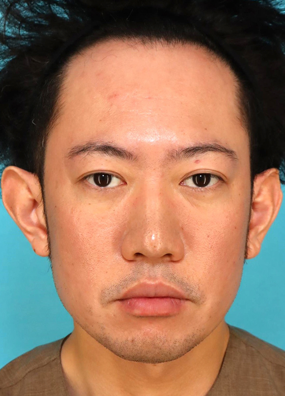 かなり分厚い唇を手術で薄くした30代男性の症例写真,After（6ヶ月後）,ba_usuku027_a01.jpg
