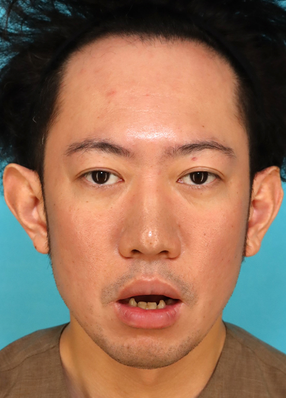 症例写真,かなり分厚い唇を手術で薄くした30代男性の症例写真,After(6ヶ月後),ba_usuku027_b02.jpg