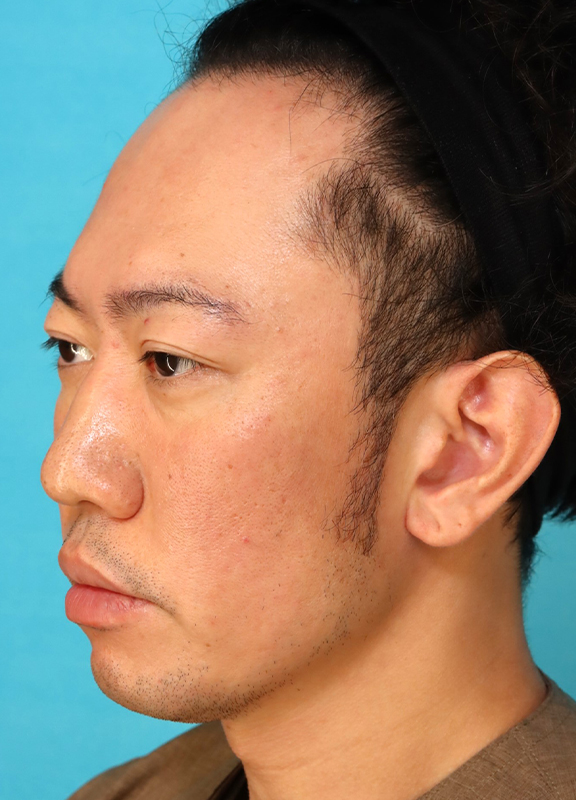 症例写真,かなり分厚い唇を手術で薄くした30代男性の症例写真,After(6ヶ月後),ba_usuku027_b03.jpg