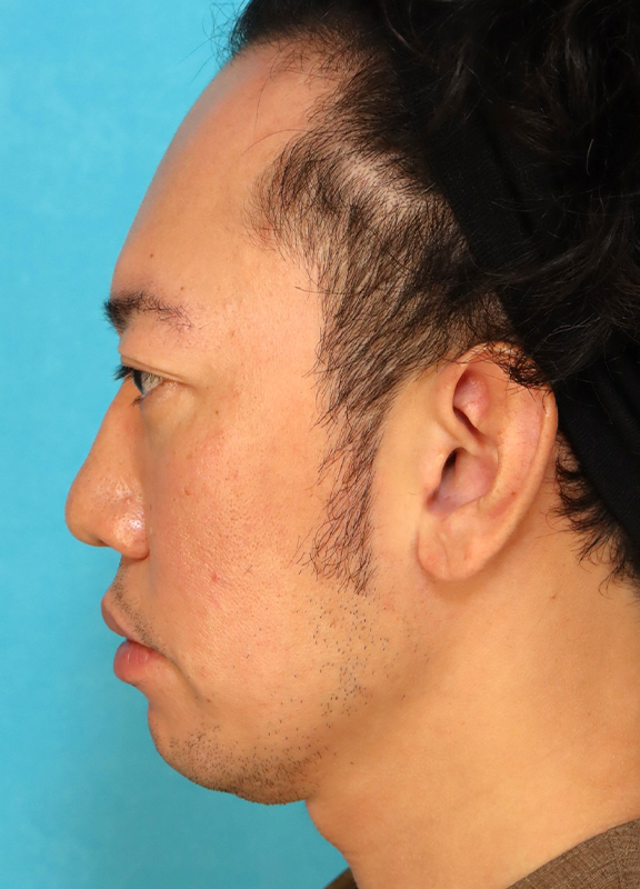 症例写真,かなり分厚い唇を手術で薄くした30代男性の症例写真,After(6ヶ月後),ba_usuku027_b04.jpg