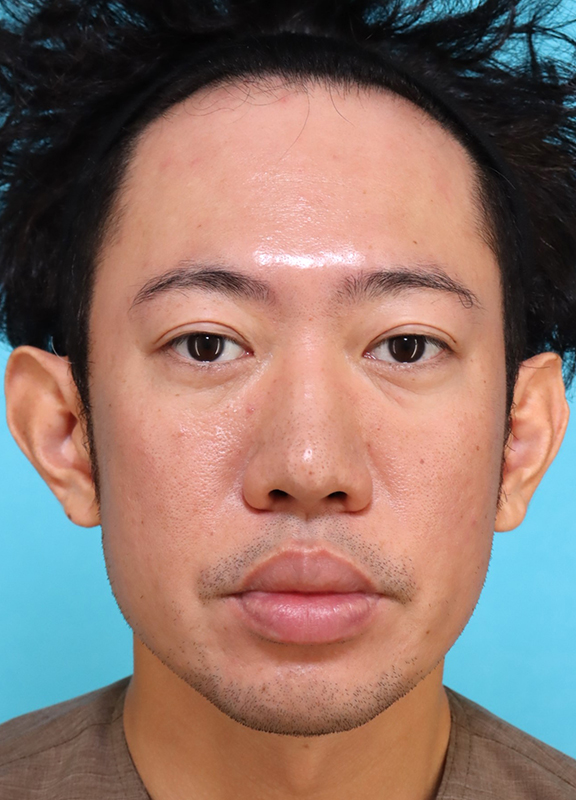 かなり分厚い唇を手術で薄くした30代男性の症例写真,Before,ba_usuku027_b01.jpg