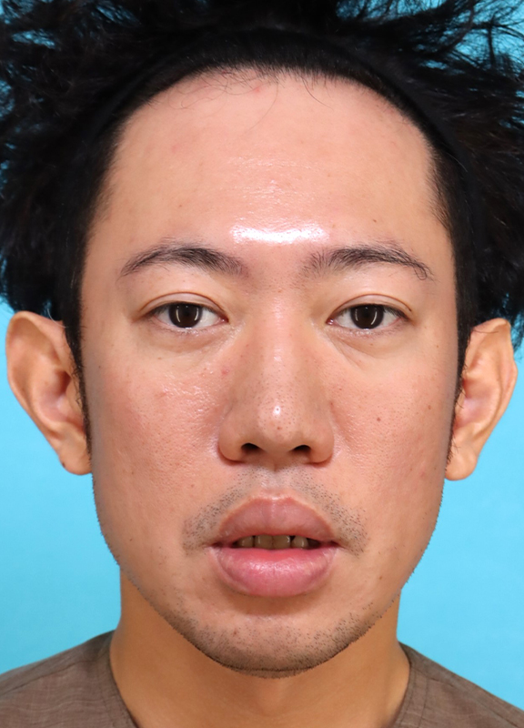 症例写真,かなり分厚い唇を手術で薄くした30代男性の症例写真,Before,ba_usuku027_b02.jpg