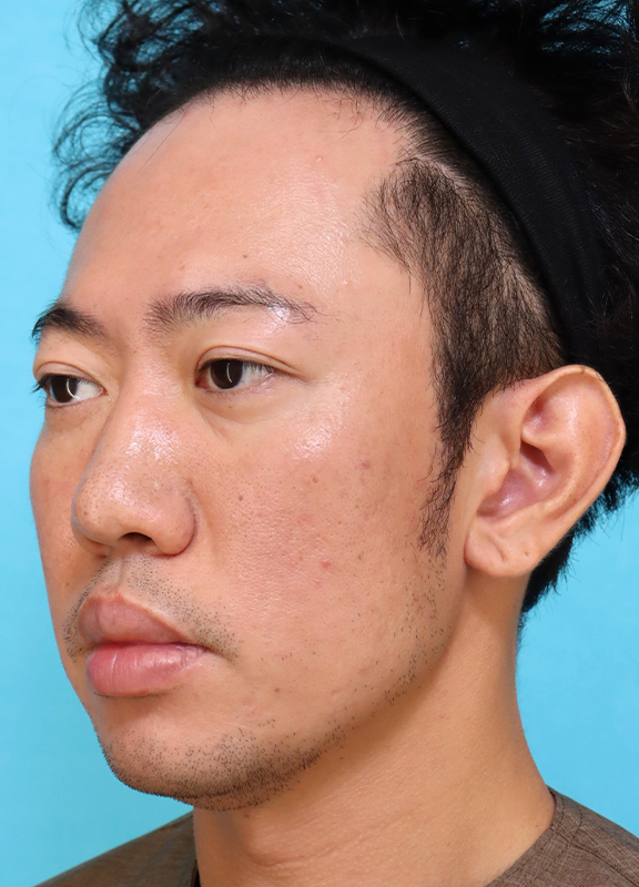 症例写真,かなり分厚い唇を手術で薄くした30代男性の症例写真,Before,ba_usuku027_b03.jpg