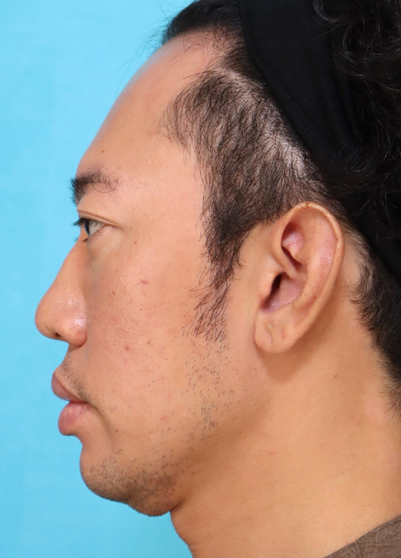 症例写真,かなり分厚い唇を手術で薄くした30代男性の症例写真,Before,ba_usuku027_b04.jpg