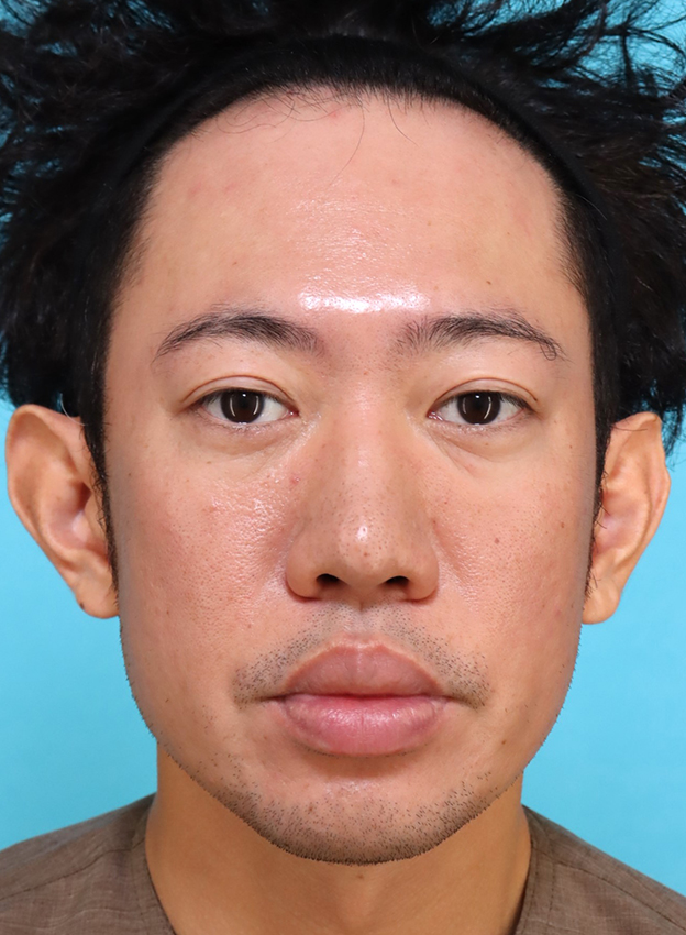 唇を薄く（口唇縮小術）,かなり分厚い唇を手術で薄くした30代男性の症例写真,手術前,口を閉じた状態,mainpic_usuku027a.jpg