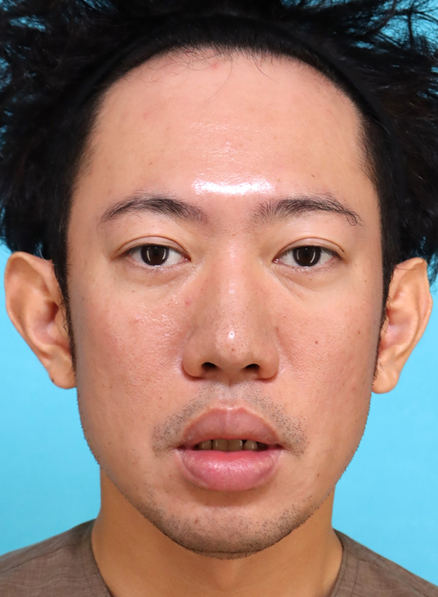 唇を薄く（口唇縮小術）,かなり分厚い唇を手術で薄くした30代男性の症例写真,手術前,口を開けた状態,mainpic_usuku027b.jpg