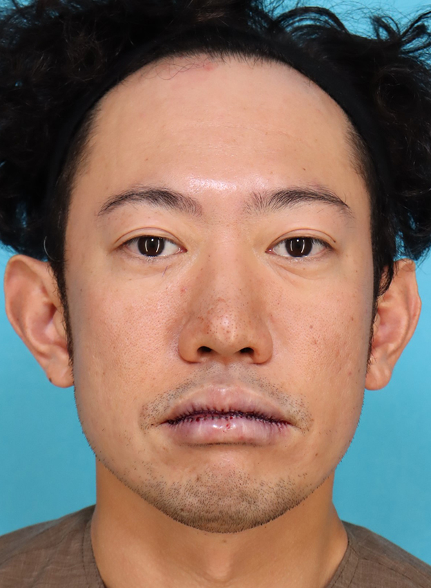唇を薄く（口唇縮小術）,かなり分厚い唇を手術で薄くした30代男性の症例写真,手術直後,口を閉じた状態,mainpic_usuku027c.jpg
