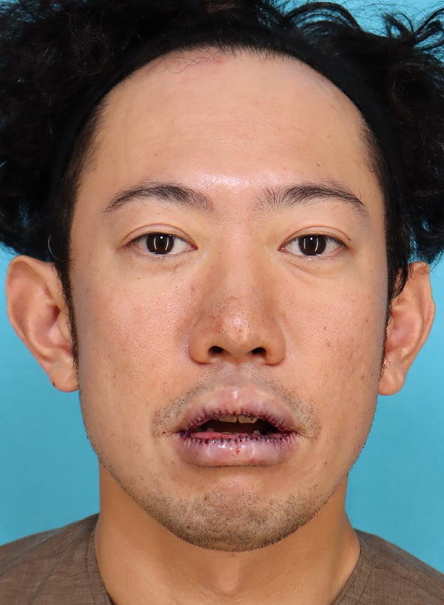 唇を薄く（口唇縮小術）,かなり分厚い唇を手術で薄くした30代男性の症例写真,手術直後,口を開けた状態,mainpic_usuku027d.jpg
