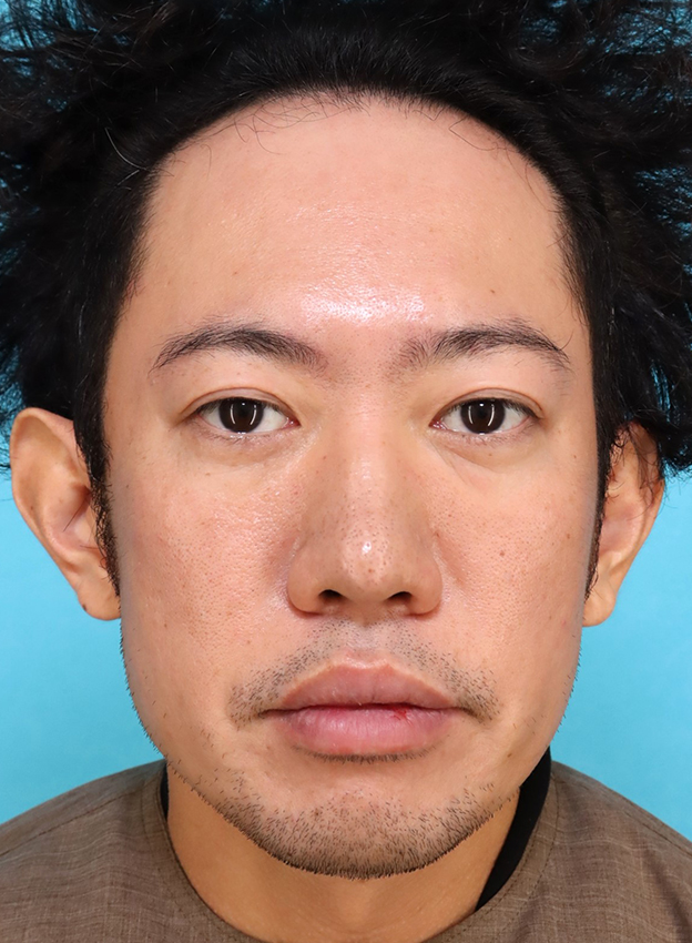 唇を薄く（口唇縮小術）,かなり分厚い唇を手術で薄くした30代男性の症例写真,10日後,口を閉じた状態,mainpic_usuku027e.jpg
