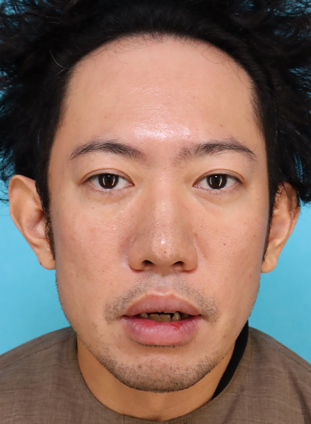 唇を薄く（口唇縮小術）,かなり分厚い唇を手術で薄くした30代男性の症例写真,10日後,口を開けた状態,mainpic_usuku027f.jpg
