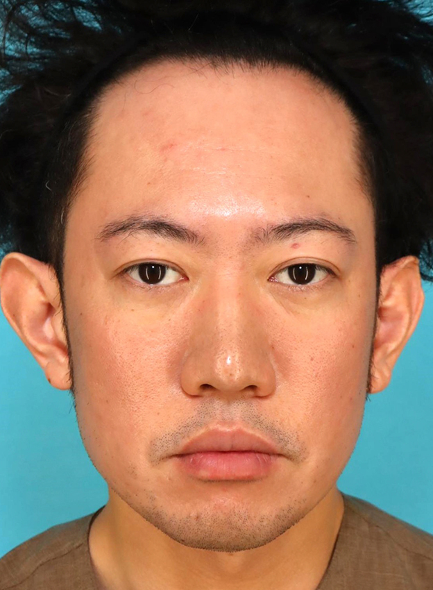 唇を薄く（口唇縮小術）,かなり分厚い唇を手術で薄くした30代男性の症例写真,6ヶ月後,口を閉じた状態,mainpic_usuku027g.jpg