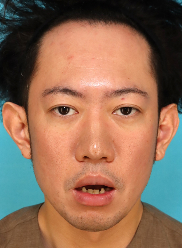 唇を薄く（口唇縮小術）,かなり分厚い唇を手術で薄くした30代男性の症例写真,6ヶ月後,口を開けた状態,mainpic_usuku027h.jpg
