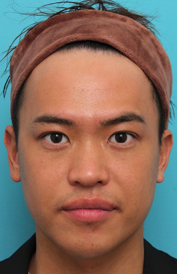 二重まぶた・埋没法,埋没法二針固定で自然な末広型二重を作った30代男性の症例写真,After（3ヶ月後）,ba_maibotsu085_a01.jpg