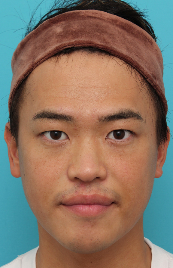 二重まぶた・埋没法,埋没法二針固定で自然な末広型二重を作った30代男性の症例写真,Before,ba_maibotsu085_b01.jpg