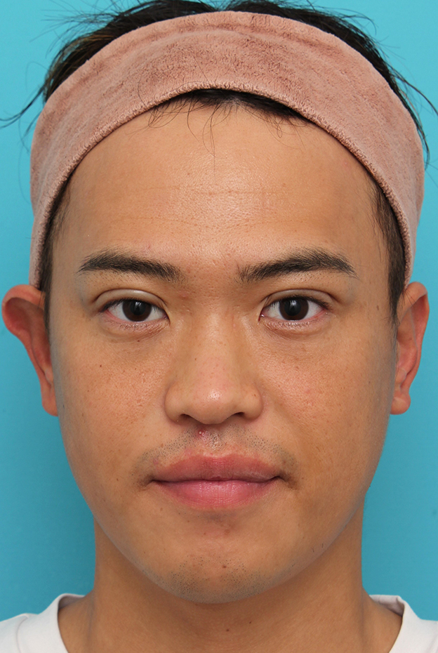 症例写真,埋没法二針固定で自然な末広型二重を作った30代男性の症例写真,手術直後,mainpic_maibotsu085b.jpg