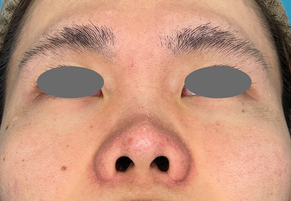 症例写真,鼻翼縮小で鼻の穴と鼻翼を小さくした症例写真,After(3ヶ月後),ba_biyoku061_b02.jpg