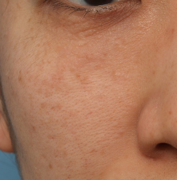 ポテンツァ,ポテンツァで汗管腫治療を行った症例写真,After（3回目照射後3ヶ月）,ba_potenza008_a01.jpg