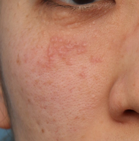 ポテンツァ,ポテンツァで汗管腫治療を行った症例写真,Before,ba_potenza008_b01.jpg
