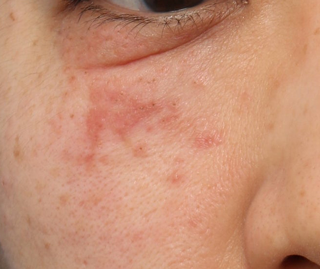 症例写真,ポテンツァで汗管腫治療を行った症例写真,2回目照射直後,mainpic_potenza008c.jpg