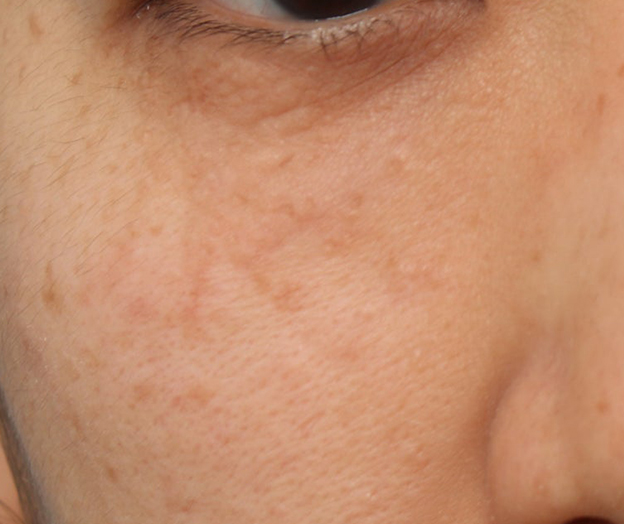 症例写真,ポテンツァで汗管腫治療を行った症例写真,3回目照射後1ヶ月,mainpic_potenza008d.jpg