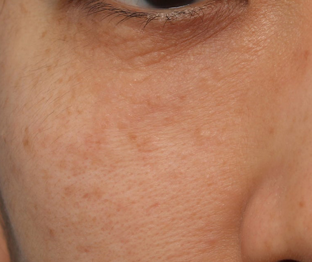 症例写真,ポテンツァで汗管腫治療を行った症例写真,3回目照射後3ヶ月,mainpic_potenza008e.jpg