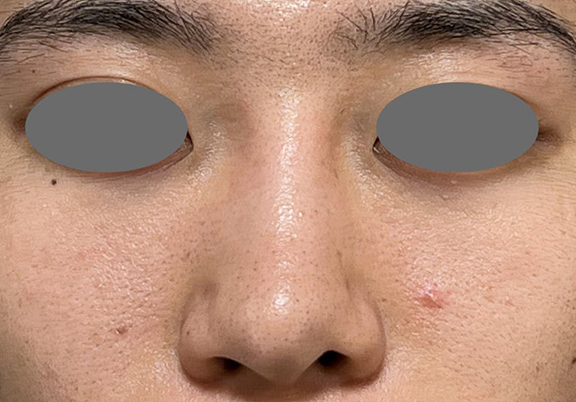 鼻尖形成(鼻尖縮小・だんご鼻修正),鼻尖形成+耳介軟骨移植で鼻の高さを出した症例写真,Before,ba_bisen032_b03.jpg