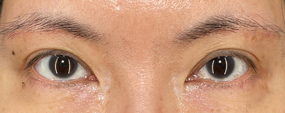 眉下リフト（上眼瞼リフト）,眉下リフトで睫毛の生え際を見せて、二重幅を広げた症例写真,After（1ヶ月後）,ba_jougankenlift014_a01.jpg