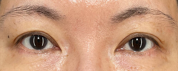 眉下リフト（上眼瞼リフト）,眉下リフトで睫毛の生え際を見せて、二重幅を広げた症例写真,Before,ba_jougankenlift014_b01.jpg