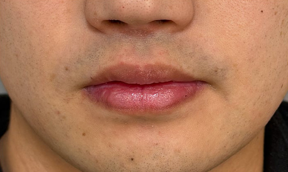 唇を薄く（口唇縮小術）,2ヶ月の時間差で口唇縮小術を行った症例写真,After（上口唇1ヶ月・下口唇3ヶ月後）,ba_usuku028_a01.jpg