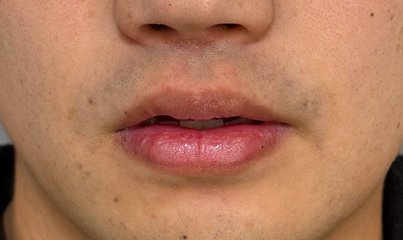 症例写真,2ヶ月の時間差で口唇縮小術を行った症例写真,After（上口唇1ヶ月・下口唇3ヶ月後）,ba_usuku028_b02.jpg
