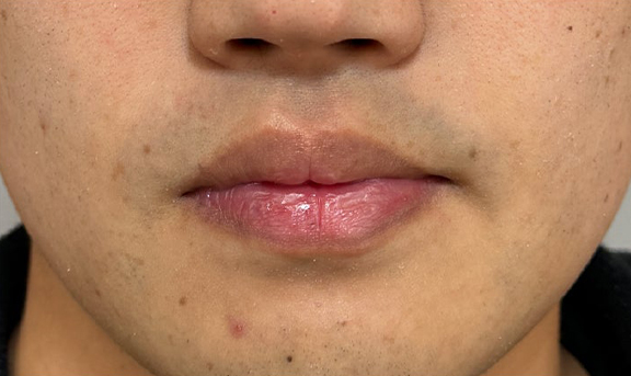 唇を薄く（口唇縮小術）,2ヶ月の時間差で口唇縮小術を行った症例写真,Before,ba_usuku028_b01.jpg