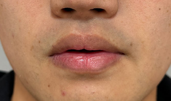 症例写真,2ヶ月の時間差で口唇縮小術を行った症例写真,Before,ba_usuku028_b02.jpg