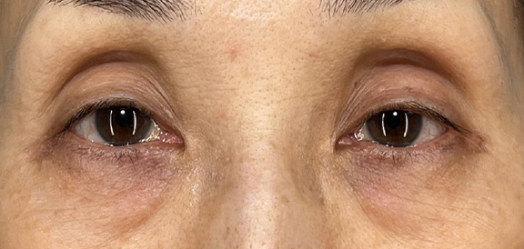眼瞼下垂手術＋表ハムラを行った症例写真,Before,ba_ganken051_b01.jpg
