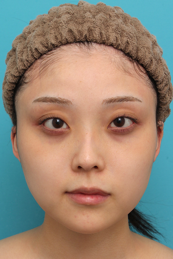 あご形成（シリコンプロテーゼ）,シリコンプロテーゼで顎をシャープに前方に出した20代女性の症例写真,After（4ヶ月後）,ba_ago028_a01.jpg