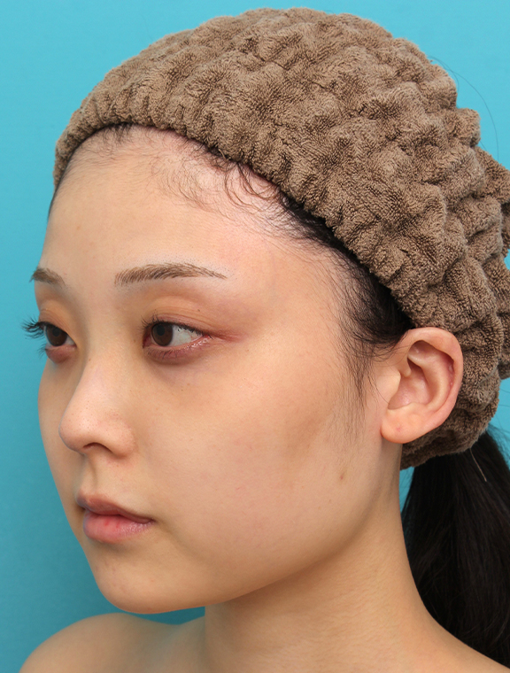 あご形成(シリコンプロテーゼ),シリコンプロテーゼで顎をシャープに前方に出した20代女性の症例写真,After(4ヶ月後),ba_ago028_b02.jpg