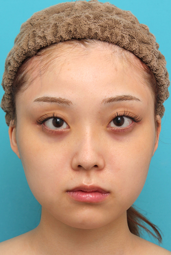 あご形成（シリコンプロテーゼ）,シリコンプロテーゼで顎をシャープに前方に出した20代女性の症例写真,Before,ba_ago028_b01.jpg