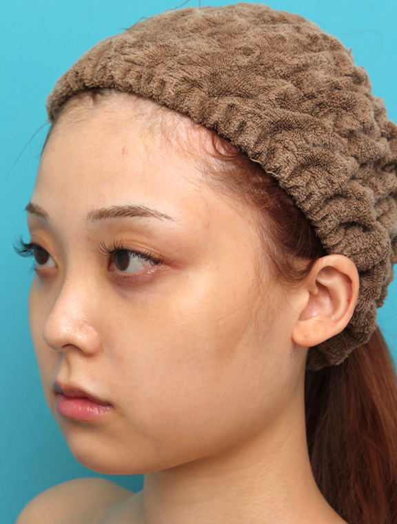 あご形成(シリコンプロテーゼ),シリコンプロテーゼで顎をシャープに前方に出した20代女性の症例写真,Before,ba_ago028_b02.jpg
